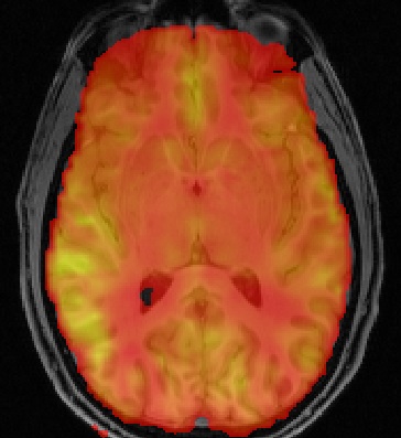 BASIL perfusion BASIL perfusion